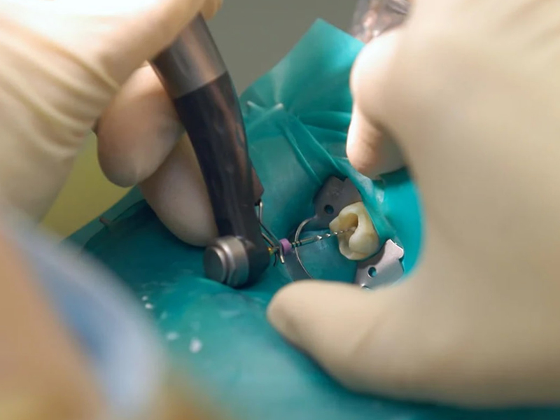чистка канала при лечении зуба-2.jpg