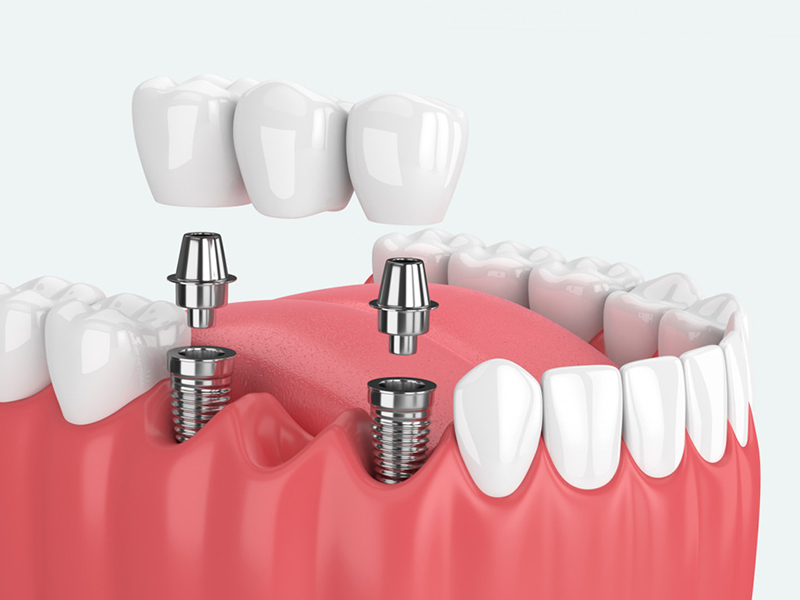 Процесс установки зубного моста на импланты.jpg