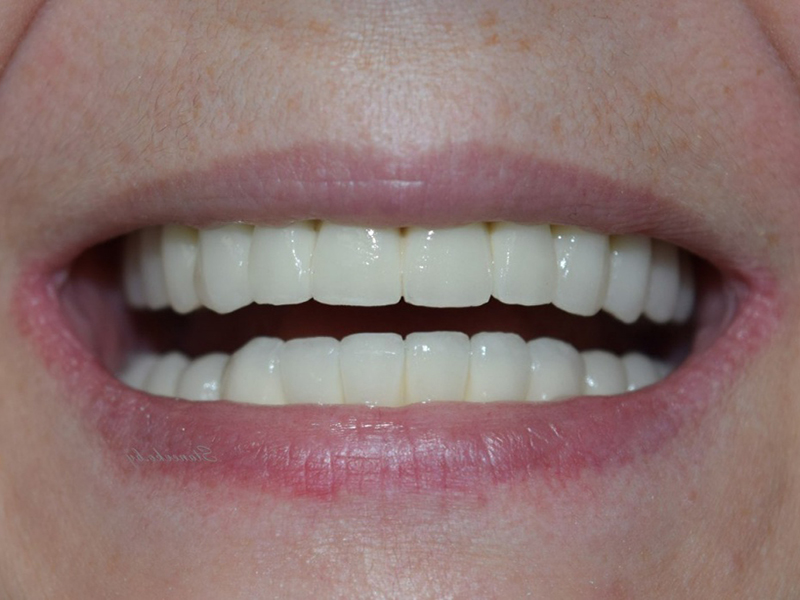 Процесс восстановления зубного ряда по технологии All-on-4.jpeg