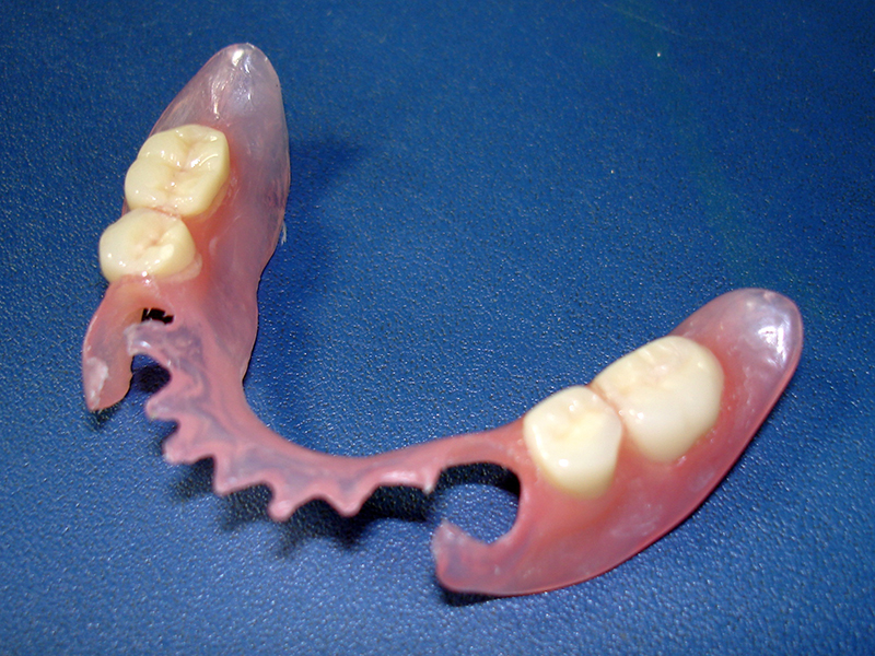 semnye-zubnye-protezy--osobennosti-vybora--izgotovleniya-i-ustanovki3.jpg