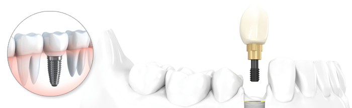 Восстановление зубного ряда на 4 имплантатах