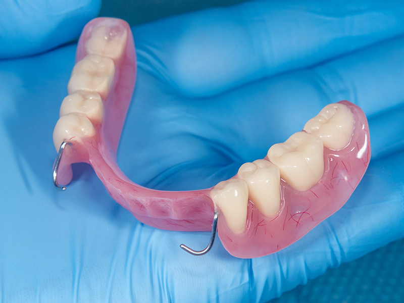 semnye-zubnye-protezy--osobennosti-vybora--izgotovleniya-i-ustanovki1.jpg